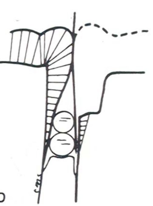 <ul><li><p>stacked wedging</p></li><li><p>used for deep and large gingival embrasures (recession)</p></li></ul><p></p>