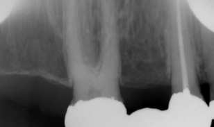 <p>Film Bending </p><p><strong>What it looks like:</strong><br>Distorted or warped image.</p><p> </p><p><strong>Cause:</strong><br>Receptor <strong>bent inside the mouth</strong>.</p>