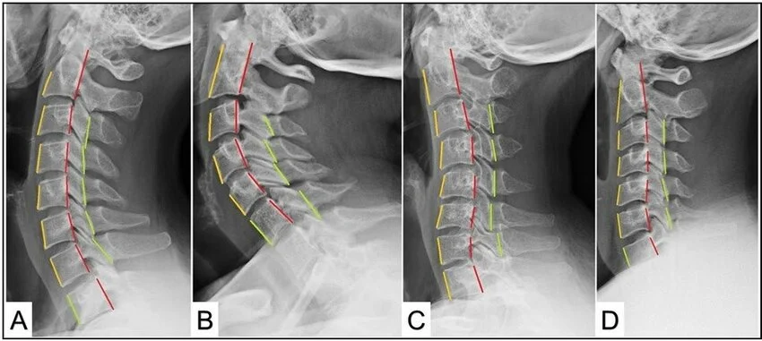 <ol><li><p>cervicalis re (qafa militare)</p></li><li><p>lordosis exessiva (tepër e theksuar)</p></li><li><p>kyphosis cervicalis (gungaç)</p></li></ol><p></p>