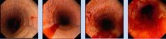 <p>You can score blood in the trachea. What is the scale?</p>