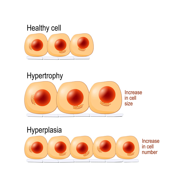 <p>Hyperplasia (proliferation) (an abnormal increase in the number of cells in an organ or tissue, which causes it to enlarge)</p>