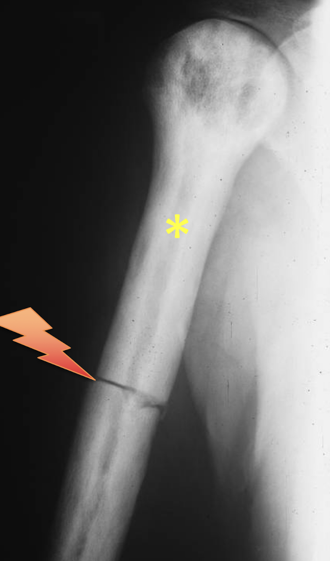 <p>What tumour like disorder is this? What fracture can be seen?</p>
