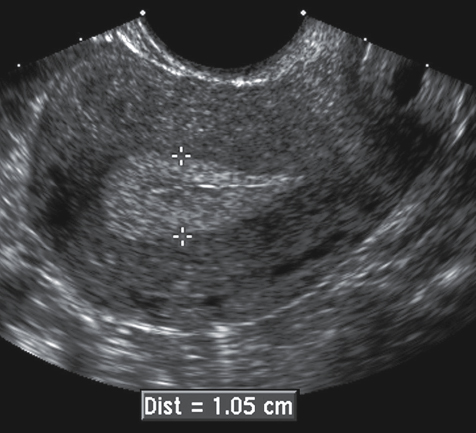 <p>the secretory endometrium is maintained by the production of progesterone because the endometrium becomes thickened and echogenic in appearance (7 and 14 mm)</p>