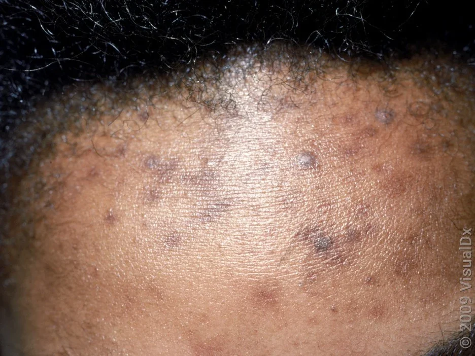 <p>Hyperpigmented </p>