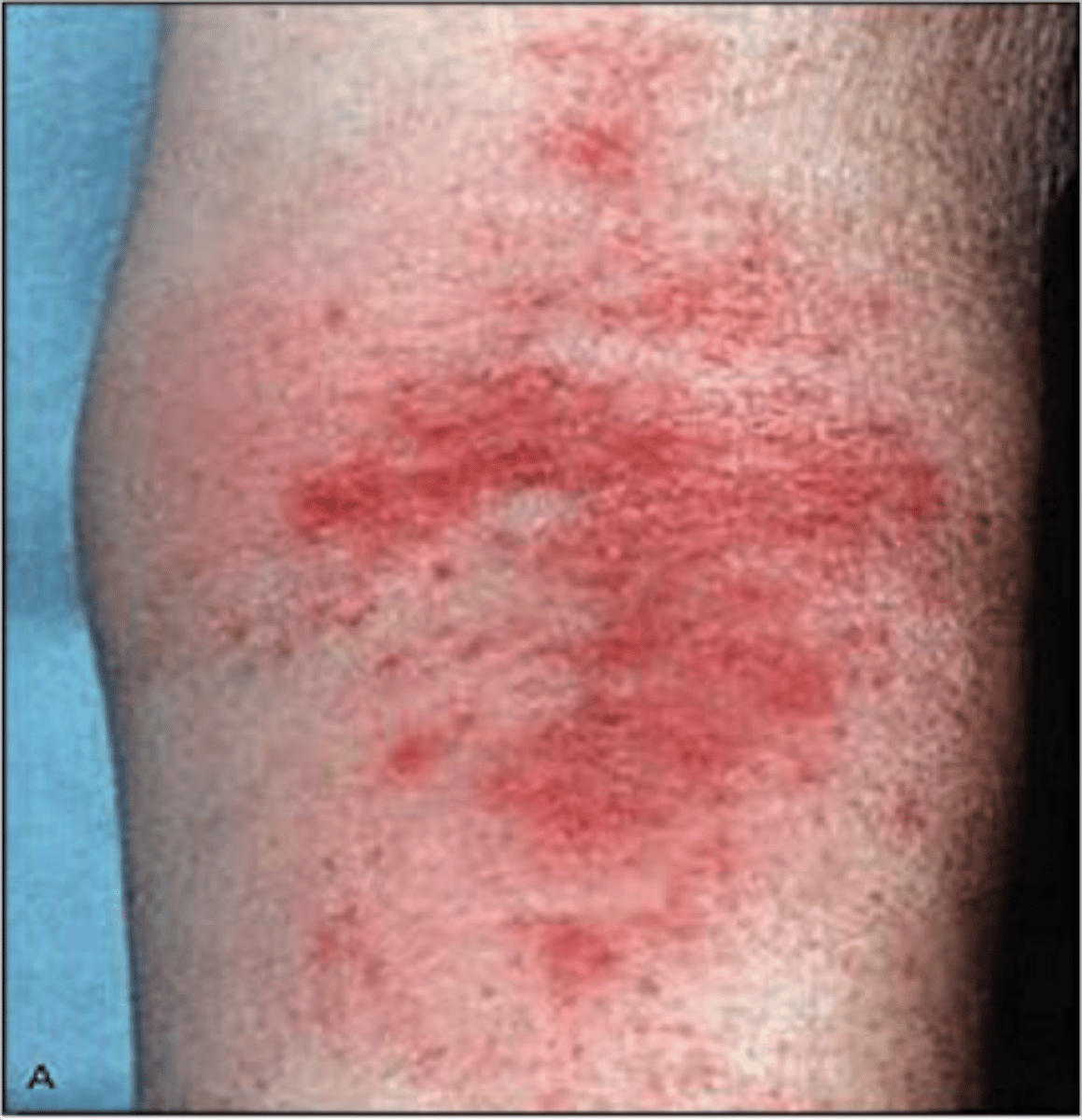 <p>eryhtematous scaling papules/plaques, lichenification (chronic)</p><p>"itch that rashes"</p>