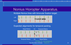 <p>Expected Alignment for Temporal Packing (Pic)</p><p>**β angle on the temporal retinas are smaller and thus the lines will appear closer together in these locations</p>