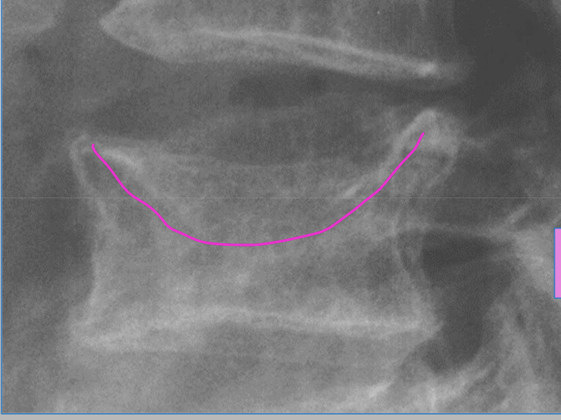 <p>A pathological fracture occurs in a pt with</p>