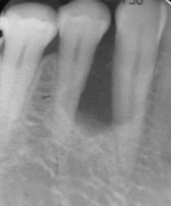 <p>48 y/o male, well defined RL, teeth vital, no pain, most likely DDx</p>