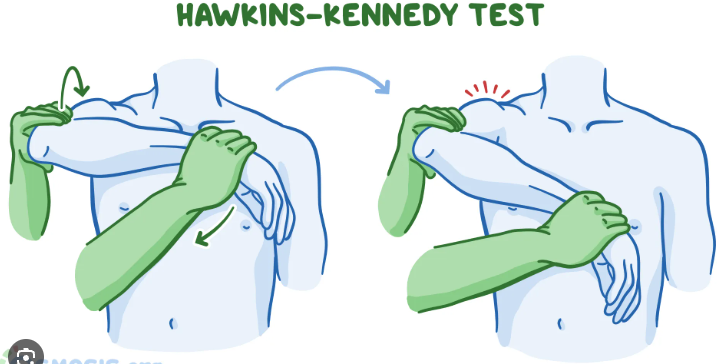<p>Hawkins Kennedy impingement test</p>