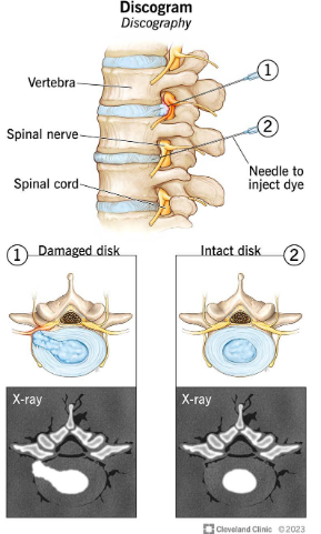 <p>Evaluates integrity and pathology of the spinal disc and can be used with contrast dye. Use x-ray or CT to access after dye is placed. </p><p>Use: Identify discs that need to be treated or removed often prior to a surgery</p>