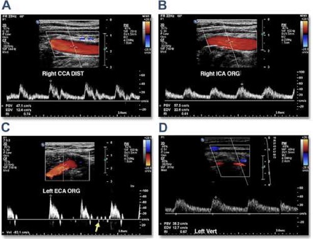 <p><u>CCA, ICA, VA</u>: low resistance vessels (arteries that supply organs that need constant forward blood flow or perfusion)</p><p><u>Carotid Bulb</u>: increase size results in pressure flow gradient</p><ul><li><p>boundary layer separation</p></li><li><p>flow entering ICA and flow reversing towards posterolateral wall</p></li></ul><p><u>ECA</u>: high resistance vessel (arteries with low or reversed flow in diastole that supply organs not in constant demand for blood flow</p><p><u>Color Flow Doppler</u>: used to evaluate lumen for narrowing, plaque, or abnormal flow; direction of flow determined</p><p><u>Spectral Doppler</u>: provides flow velocity measurements used to evaluate for stenosis; PSV and EDV using 60 degree angle or less</p><p>used to document areas of flow disturbance seen with stenosis, occlusion or trickle flow</p><p></p>