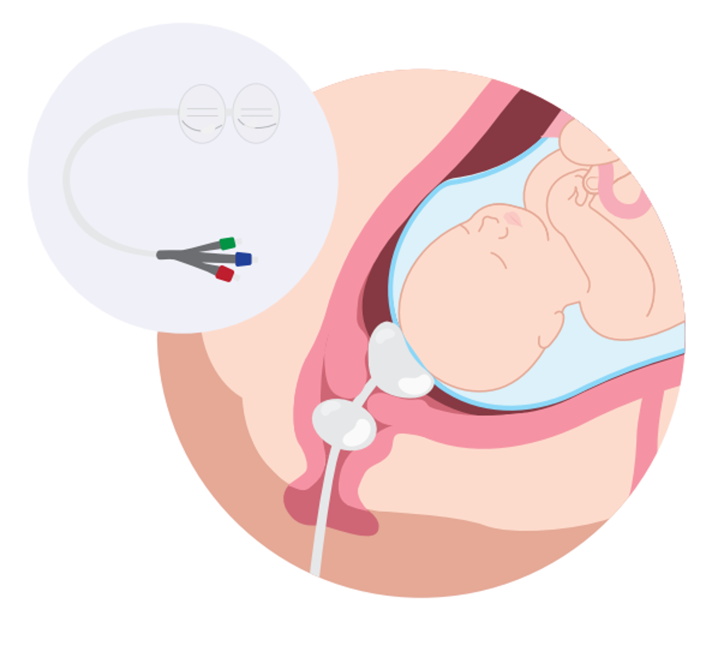 <p><span style="color: rgb(25, 118, 147);"><strong><u>Induction</u></strong>:</span></p><ul><li><p><span style="color: rgb(9, 10, 11);">starting labor</span><span style="color: rgb(25, 118, 147);"> <strong>ARTIFICIALLY </strong></span>b4 it begins (Pitocin or mechanical techniques)</p></li></ul><p><span style="color: rgb(126, 95, 239);"><strong><u>Augmentation</u></strong>:</span></p><ul><li><p><span style="color: rgb(126, 95, 239);"><strong>help labor progress</strong> <strong><u>AFTER </u></strong></span>it starts</p></li></ul><p></p>