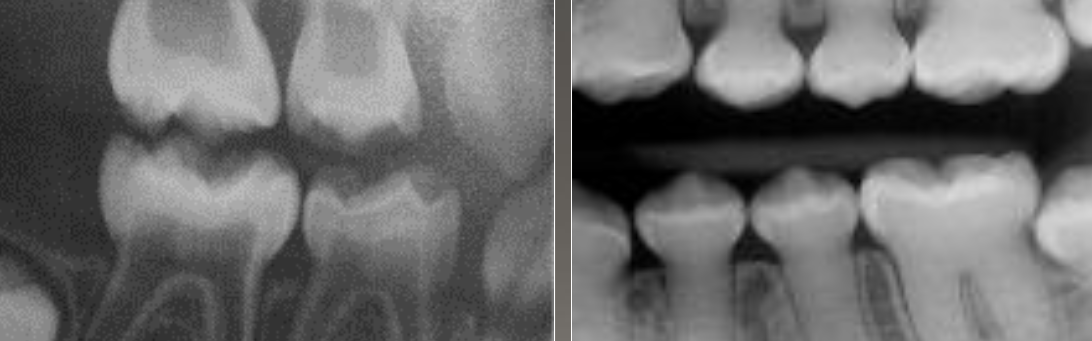 <p>DGI radiographic presentation </p>