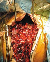 <p><span style="background-color: transparent;">Frazier Laminectomy Retractor</span></p>