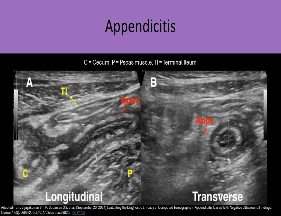 <p>A. appendicitis</p><p>A thickened aperistaltic tube that is noncompressible is a hallmark sign of appendicitis. Crohn disease refers to inflammatory disease of the bowel. Bowel segments can be thickened, aperistaltic and noncompressible but will not appear a s a blind ended tube.</p>