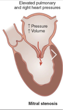 <p>What is mitral stenosis?</p>