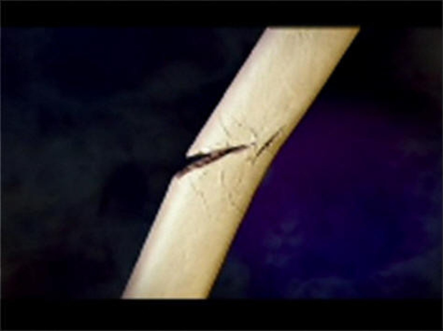 <p>gãy xương The x-ray showed a minor ___________ in his left ankle.</p>