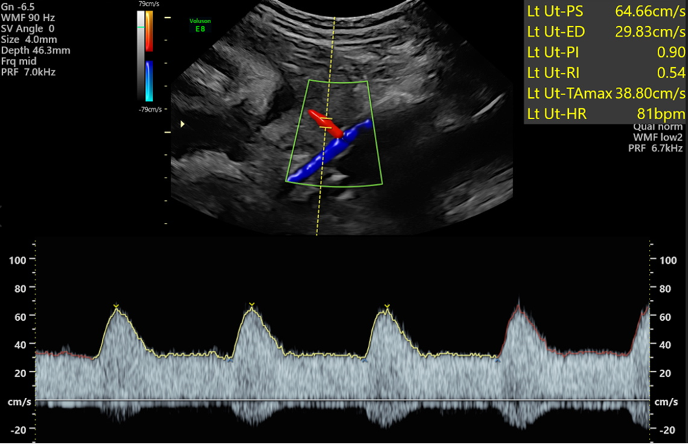 <p>maternal uterine artery doppler</p>