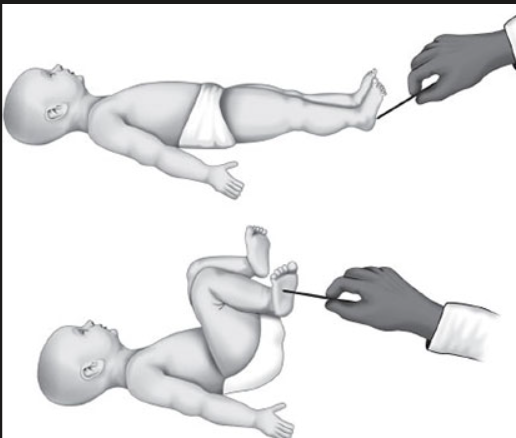 <ul><li><p>primitive reflex - spinal cord</p></li><li><p>protective, develops balance between flexor and extensor toe</p></li><li><p>stimulate sole of foot => dorsiflexion of foot and flexion of hip and knee</p></li></ul><p></p>