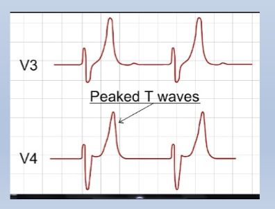 <p>-Muscle cramping/twitching (early)</p><p>-Muscle weakness/paralysis (late)</p><p>-Cardiac dysrhythmias</p><p>-Tall, peaked T waves</p>