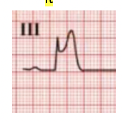 <p>An ST elevation </p>
