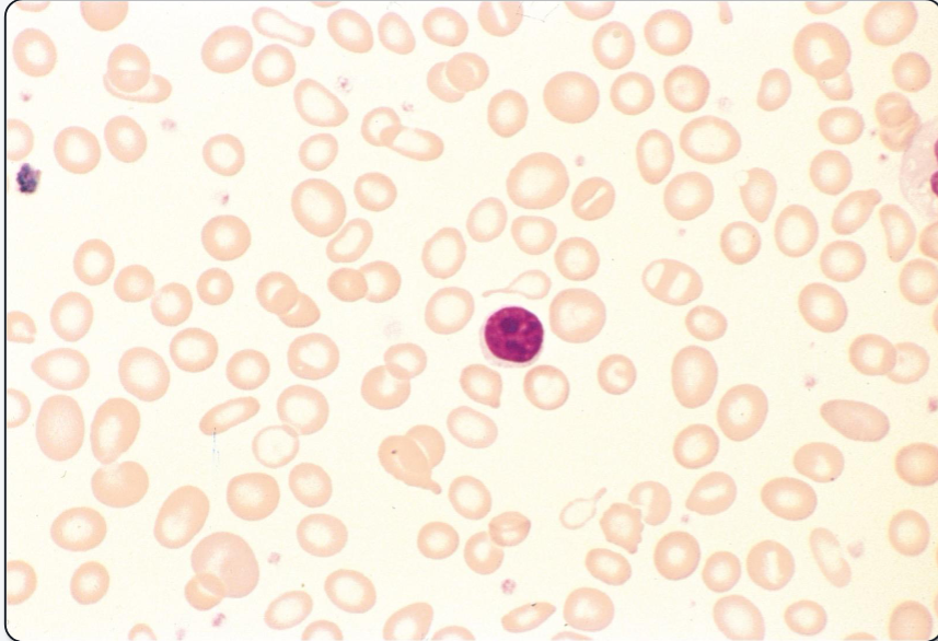 <p>What anemia does this peripheral blood smear indicate? What are the key distinguishing features?</p>