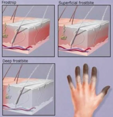 <p>- Partial skin freezing</p><p>- Numbness, erythema, edema</p><p>- No blisters</p><p>- No tissue loss</p>