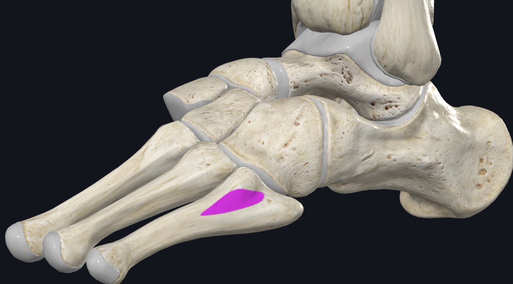 <p>Dorsum of base of 5th metatarsal</p>