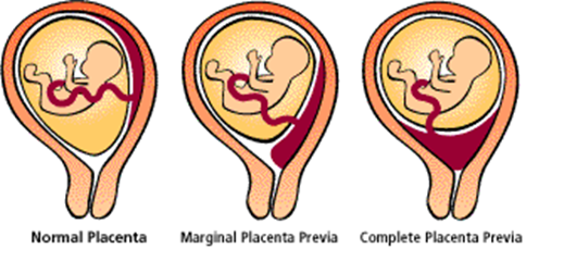 <ul><li><p><span style="font-family: "Avenir Next LT Pro";">Diagnosed with </span><span style="font-family: "Avenir Next LT Pro"; color: yellow;">ultraso</span><span style="font-family: "Avenir Next LT Pro";">und</span></p></li><li><p><span style="font-family: "Avenir Next LT Pro";">Placental implantation in the lower uterine segment over or near internal os of cervix</span></p></li><li><p><span style="font-family: "Avenir Next LT Pro"; color: yellow;">1<sup>st</sup> thought with <strong><u>painless bleeding</u></strong></span></p></li><li><p><span style="font-family: "Avenir Next LT Pro";"><strong><u>Causes</u></strong>:</span></p><ul><li><p><span style="font-family: "Avenir Next LT Pro";">Direct cause with # of C/S</span></p></li></ul></li><li><p><span style="font-family: "Avenir Next LT Pro";"><strong><u>Risks</u></strong>:</span></p><ul><li><p><span style="font-family: "Avenir Next LT Pro";">Separation, bleeding or hemorrhage</span></p></li><li><p><span style="font-family: "Avenir Next LT Pro";">Barrier</span></p></li><li><p><span style="font-family: "Avenir Next LT Pro";">2<sup>nd</sup> or 3<sup>rd</sup> trimester of pregnancy</span></p></li><li><p><span style="font-family: "Avenir Next LT Pro"; color: red;"><strong><u>No Vaginal Exam!! For fear of abruption</u></strong></span></p></li><li><p><span style="font-family: "Avenir Next LT Pro";"><strong><u>C/S</u></strong></span></p></li></ul></li></ul><p></p><p></p>