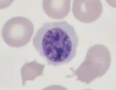 <p>M6 - erythroleukemia </p>