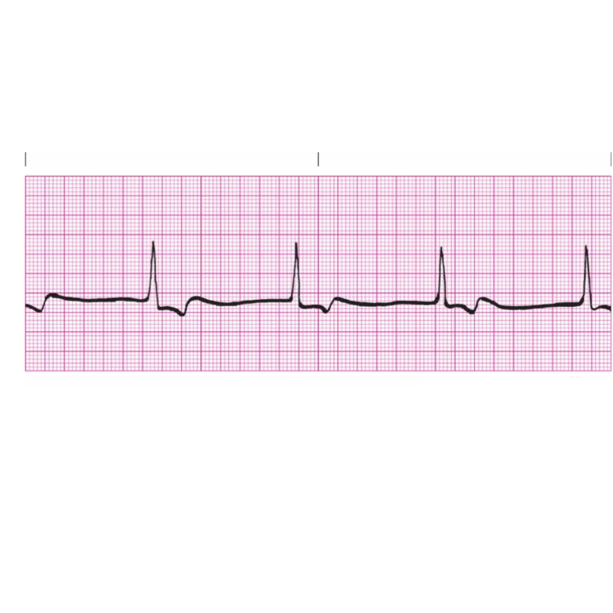 <p>Rules for Junctional Escape Rhythm includes</p>