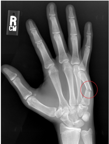 <p>Punching with closed fist places big axial load on metacarpal head causing transverse (most commonly) fracture of metacarpal shaft/head</p>