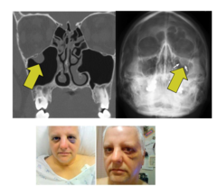 <p>fx of the inferior orbital floor (into maxillary sinus) or the medial wall of the orbit (into ethmoid sinus)</p>