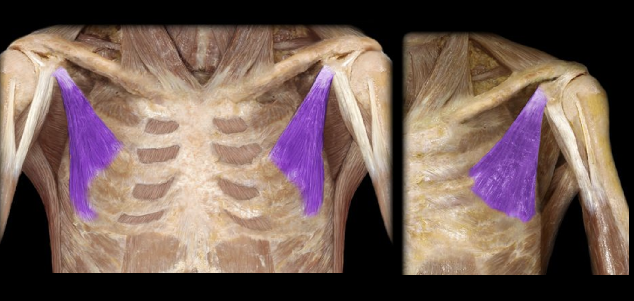 <p>Underneath the Pectoralis Major (Doesn’t reach all the way to the center</p>
