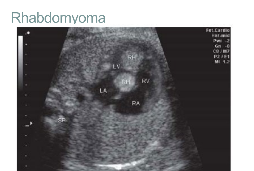 <p>Atrioventricular valve regurgitation and intracavitary obstruction </p><p>Arrhythmias and conduction abnormalities </p><p>May cause fetal myocardial dysfunction and hydrops</p>