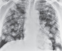 <p>This x-ray image indicates what pathology?</p>