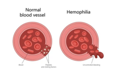 <p>A rare, inherited bleeding disorder that affects the body's ability to form blood clots.</p><p>Two forms: hemophilia A and hemophilia B</p><p>- Determined by laboratory tests</p><p>- Both are inherited as X-linked traits, making both conditions more common in males than in females</p><p>Hemophilia A is caused by a genetic defect that results in deficient or defective factor VIII. Relatively common.</p><p>Hemophilia B, known as Christmas disease, is due to a genetic defect that causes a deficiency or defect in factor IX.</p><p>Often dx in early childhood, usually in the toddler</p><p>Manifested by hemorrhages into various parts of the body</p><p>75% of bleeding occurs in the joints</p>