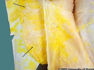 <p>what layer of fascia are the arrows pointing to</p>