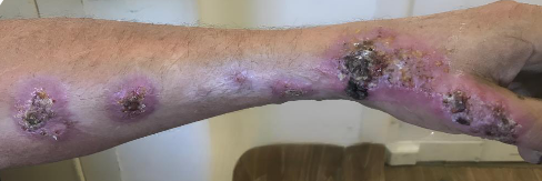 <p>Forma clásica (70%) en paciente inmunocompetentes. Inicia con una lesión primaria en el sitio de inoculación <strong>(chancro esporotricósico)</strong> que aparece como una pápula con tendencia a ulcerarse. <br><br>Desarrollan nódulos subcutáneos secundarios siguiendo el trayecto de los vasos linfátivos, configurando un <strong>patrón linfangítico ascendente </strong>característico y orientador.</p>