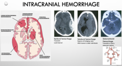 <p>bleeding between the dura mater and arachnoid mater</p>