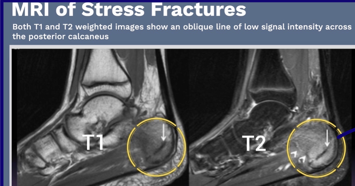 <ul><li><p>Define anatomy (T1)</p></li><li><p>Detect abnormal fluid (T2)</p><ul><li><p>Hint: H<strong>2</strong>O → T<strong>2</strong></p></li><li><p>White = edema in photo</p></li></ul></li></ul><p></p>