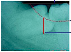 <p><span style="color: red;">occlusal level</span> of 2nd and 3rd molars</p>