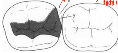 <p>y shows what kind of embrasure form?</p>