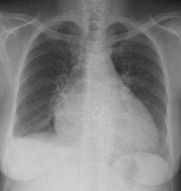 <p>the included image has an example of a mediastinal abnormality; what is it?</p>
