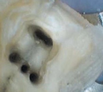 <p>What are some variations you may see in the mesial canal?</p>
