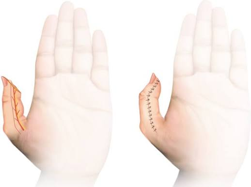 <p>Moberg Advancement Flap</p>