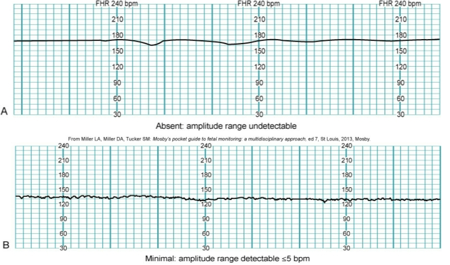 <p>nursing interventions for FHR that has loss of variability</p>