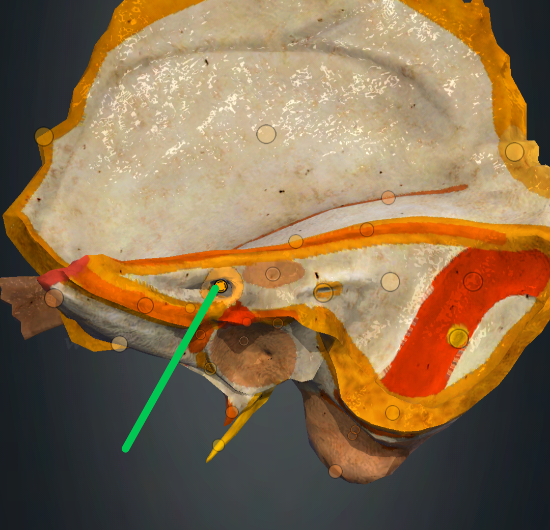 <p>porus acusticus internus</p>
