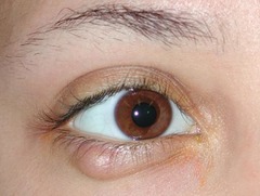 <p>subacute, nontender, non-infectious usually painless nodule caused by a blocked meibomian gland (often occurs after stye is no longer infected but gland is still blocked)</p>