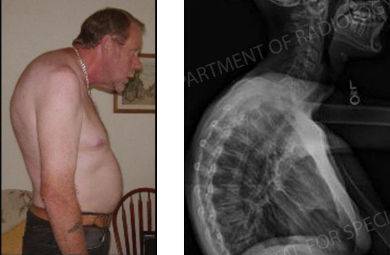 <p>kyphosis (hunch back) </p>